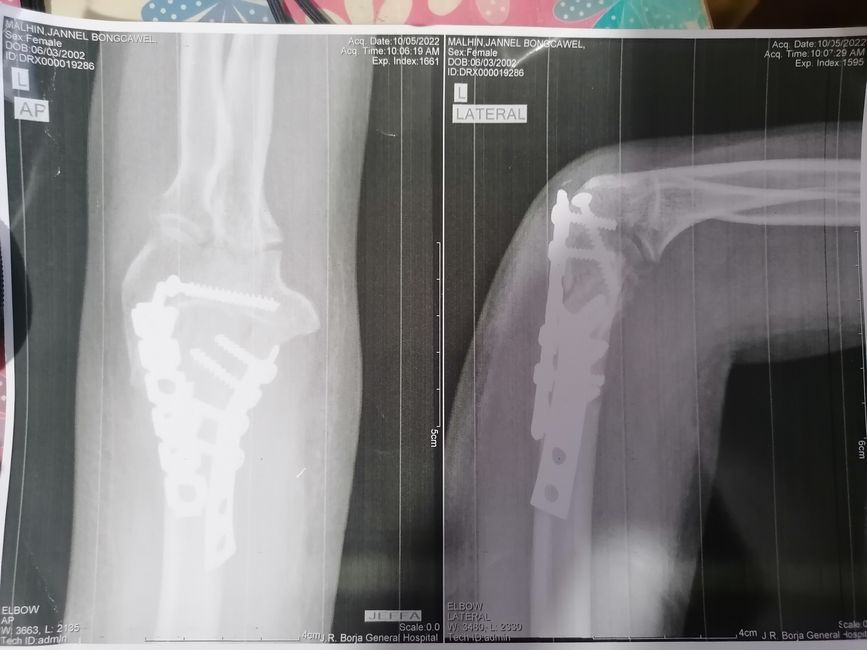 Röntgenbild des gebrochenen Arms
