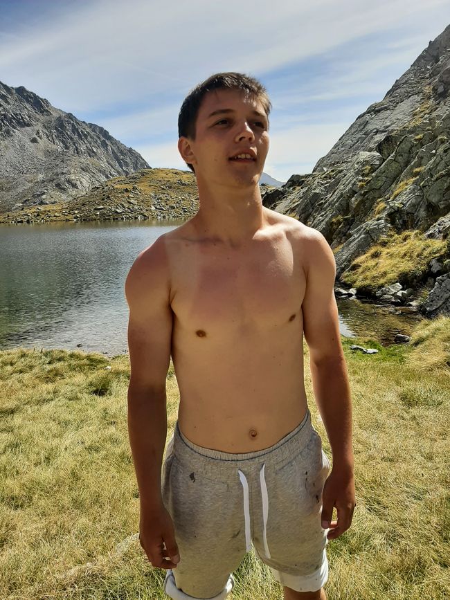 Paul with sunburn