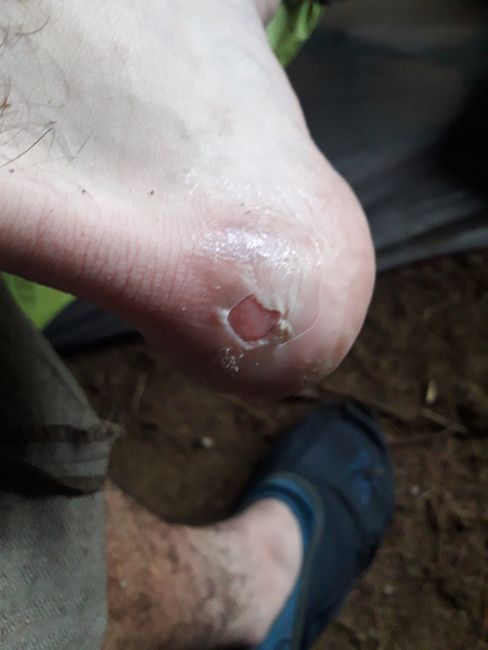 without blister plaster